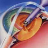 Хірургія катаракти